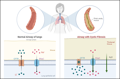 Normal airway vs cystic fibrosis airway
